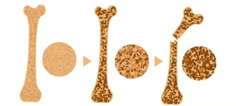 骨质疏松症不仅导致骨痛和活动受限，还可能发生骨折